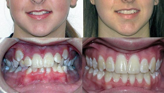 Before and After Orthodontics by Dr. Ken Lawrence Mentor OH