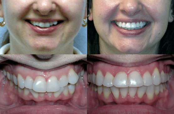 Before and After Orthodontics by Dr. Ken Lawrence Mentor OH