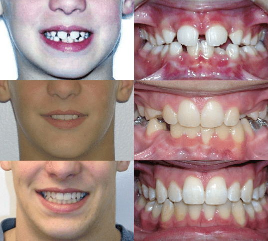 Before and After Orthodontics by Dr. Ken Lawrence Mentor OH