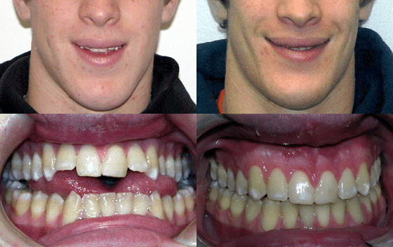Before and After Orthodontics by Dr. Ken Lawrence Mentor OH