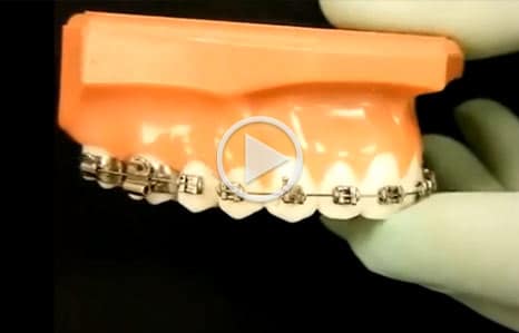 Emergency care video - Orthodontics by Dr. Ken Lawrence in Mentor, OH
