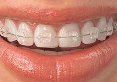 Ceramic-Braces